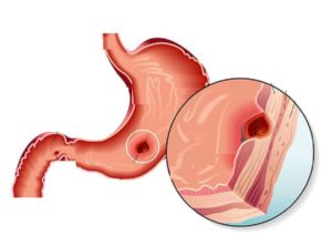 Pernicious Anemia - Causes, Types, And Cure