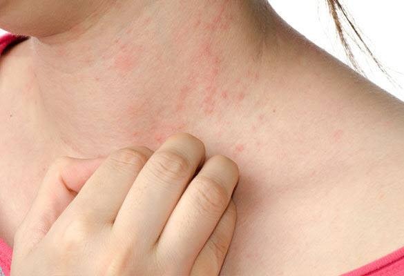 Workable Eczema Treatment