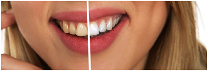 How To Naturally Whiten Your Teeth 