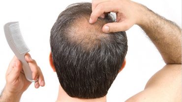 Best Hair Loss Treatments for Men