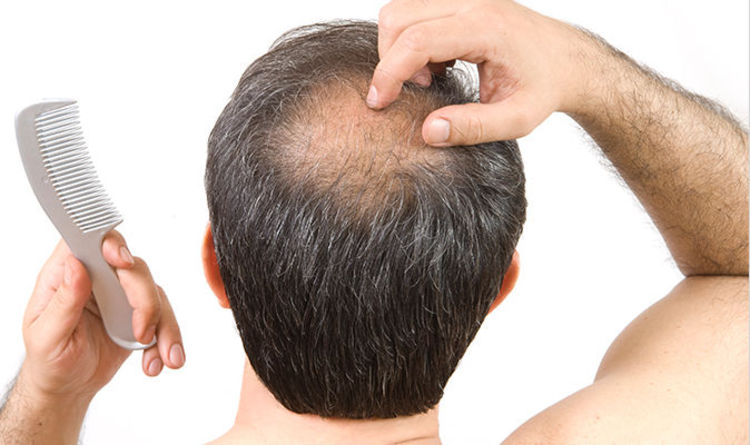 Best Hair Loss Treatments for Men